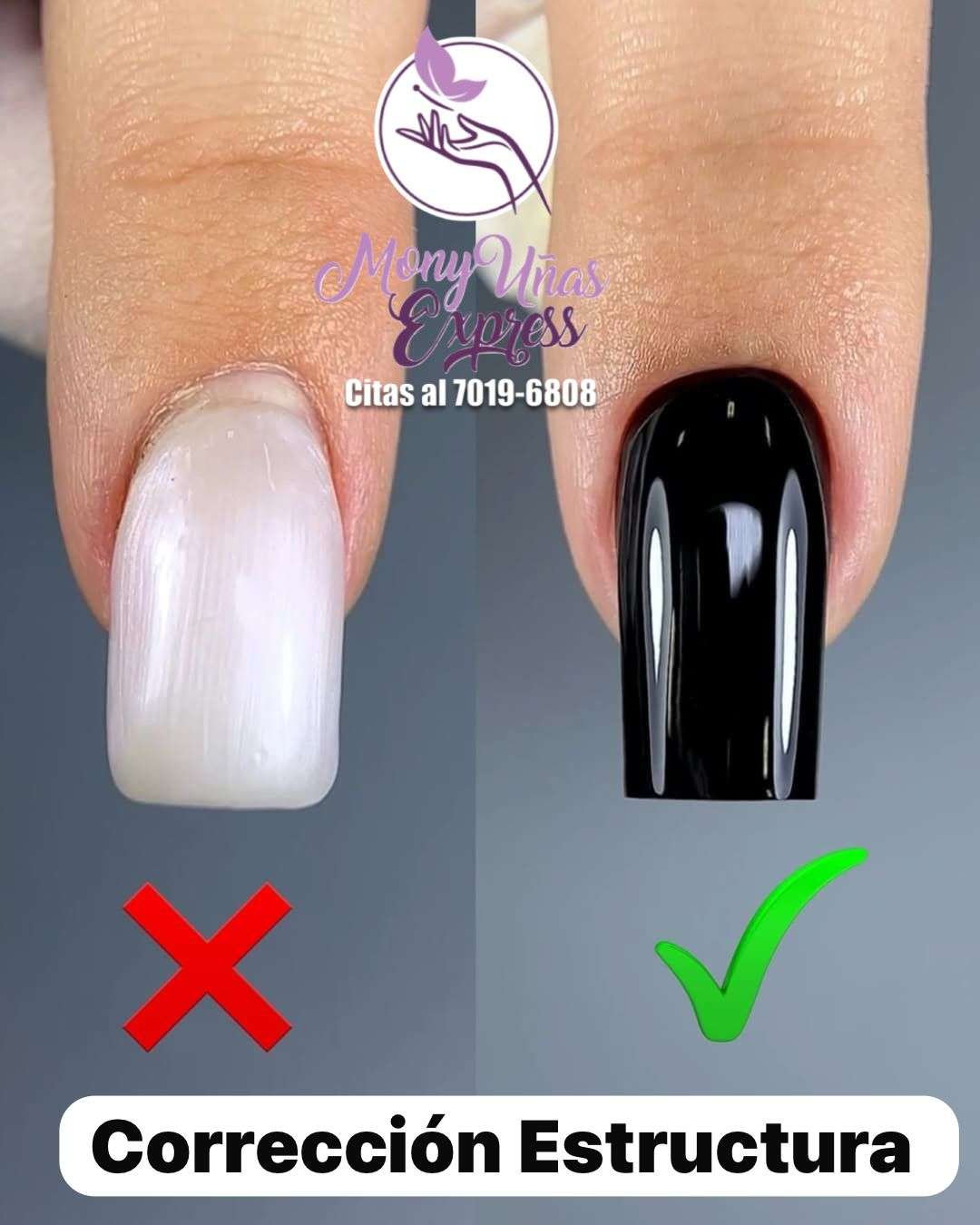 Corrección de Estructura Ungueal
