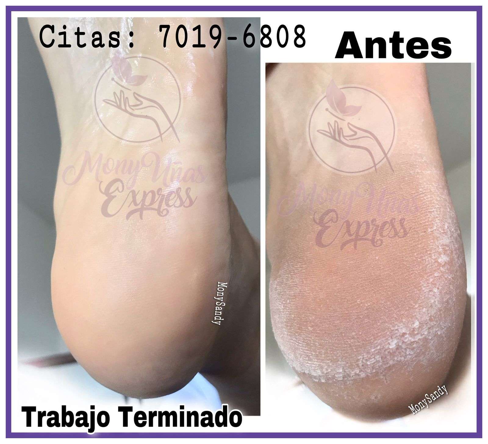 Extracción Callos