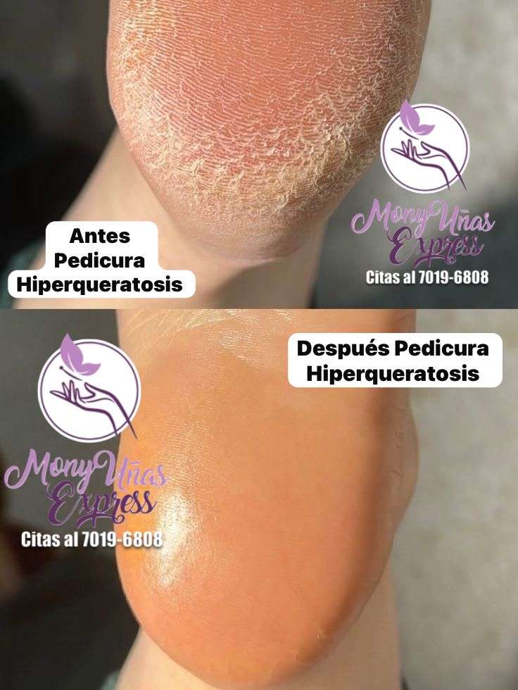 Pedicura Hiperqueratosis