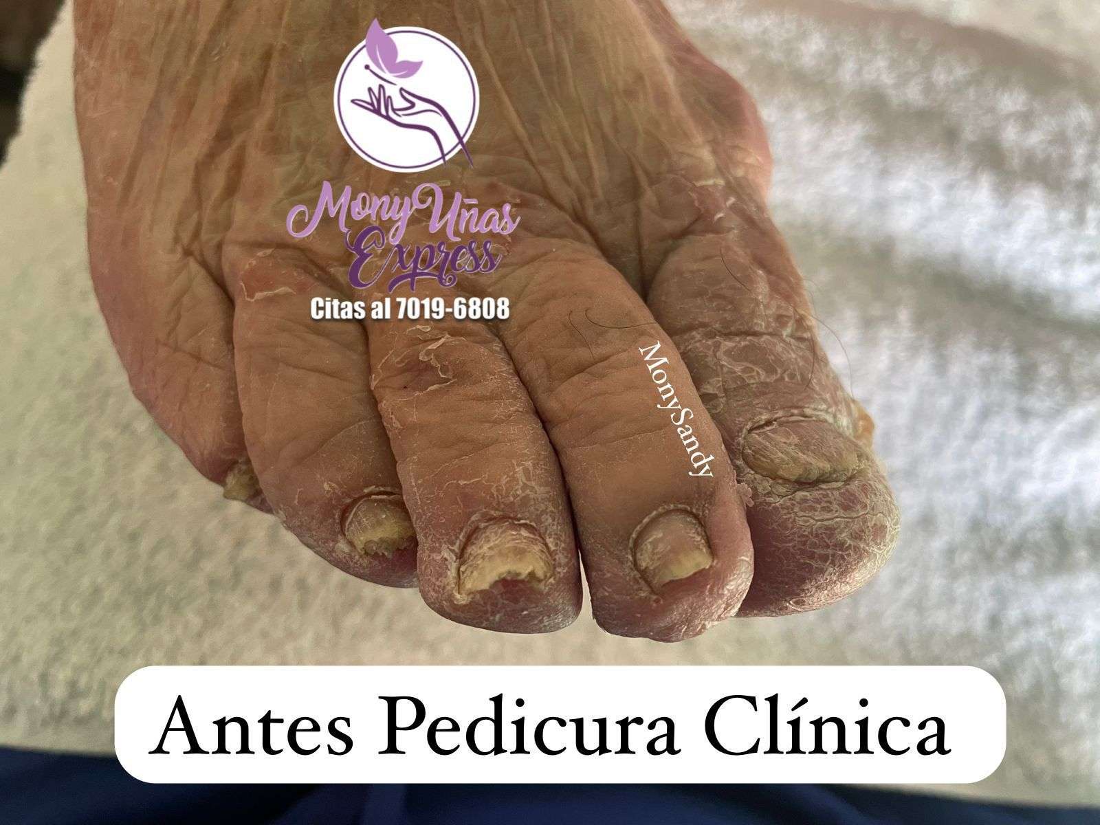 Pedicura Onicogrifosis