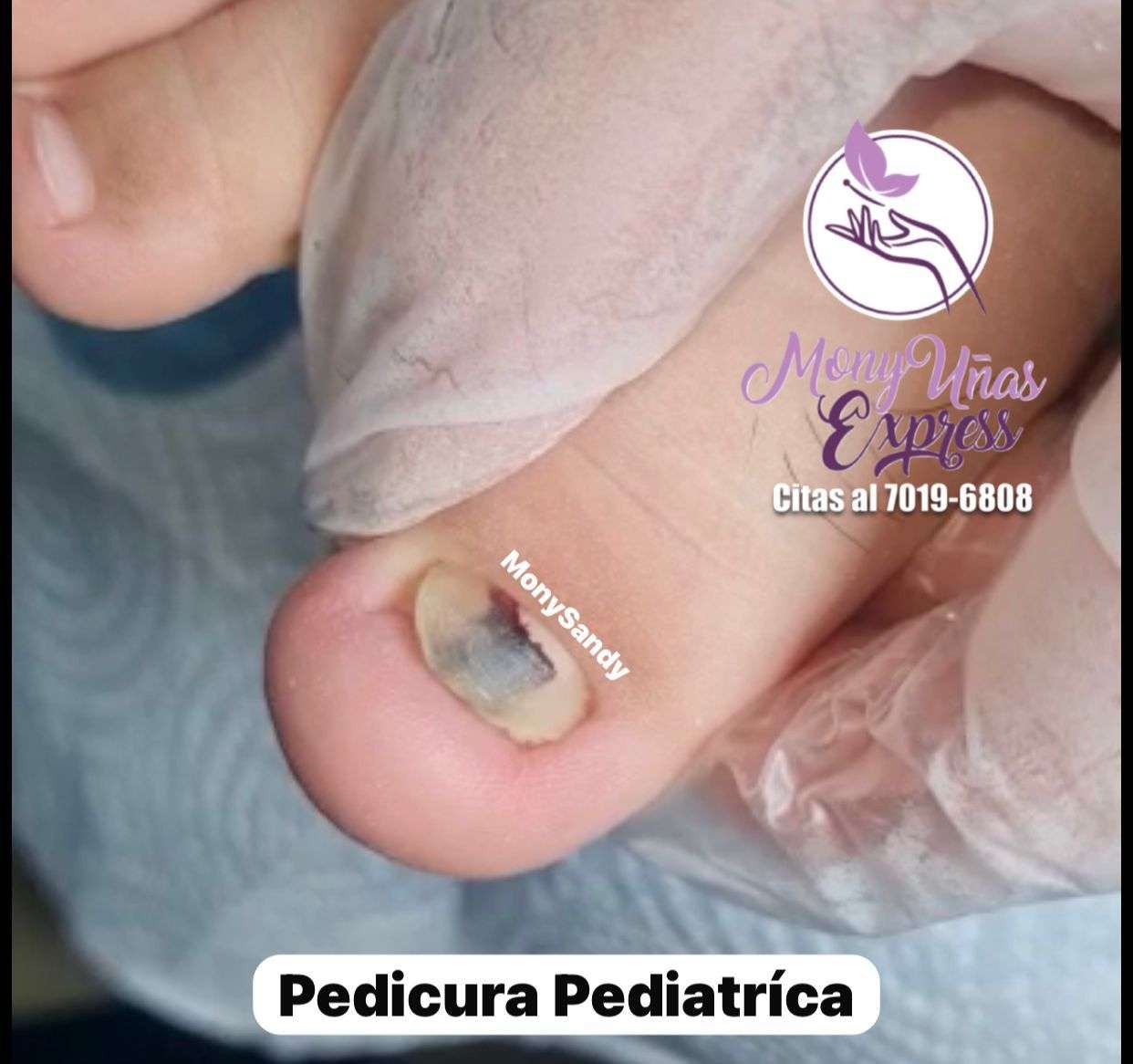 Pedicura Pediátrica (Según Caso)