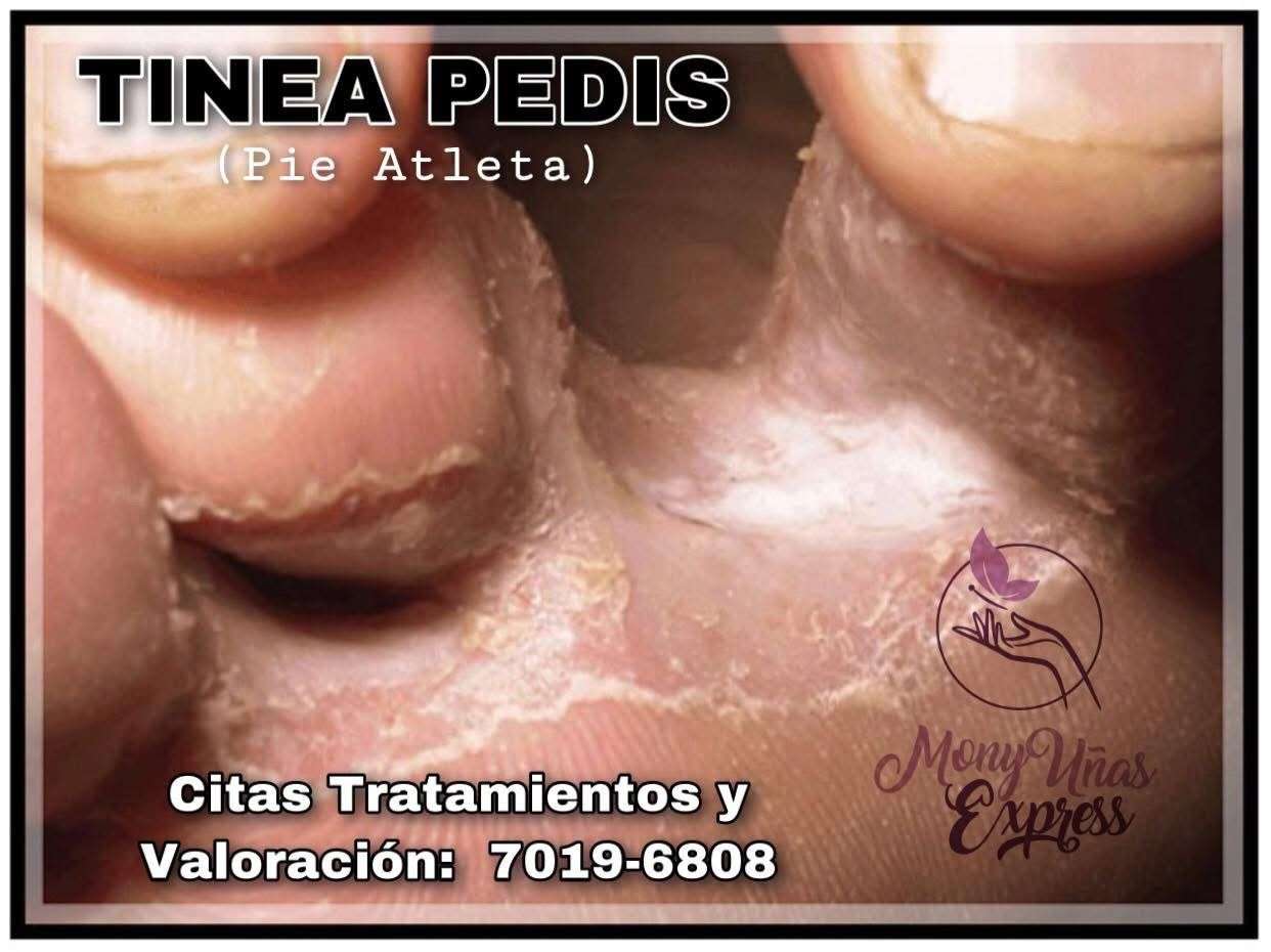 Pedicura Tiña Pedi